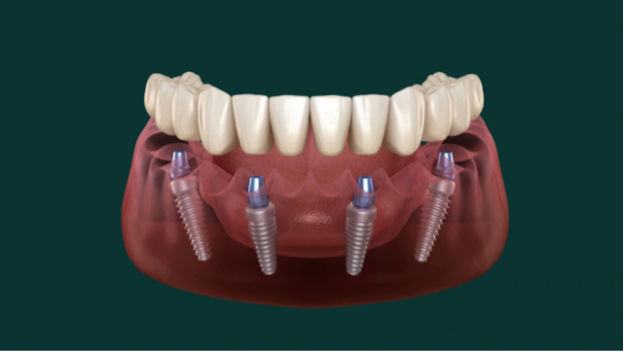 All-on-4 Implants