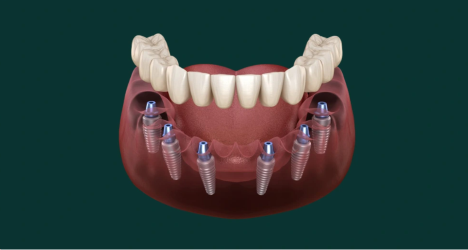 All-on-6 Implants