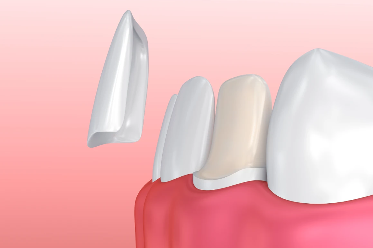 Dental Veneers